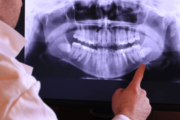 Best Emergency Tooth Extraction in Memphis, TX
