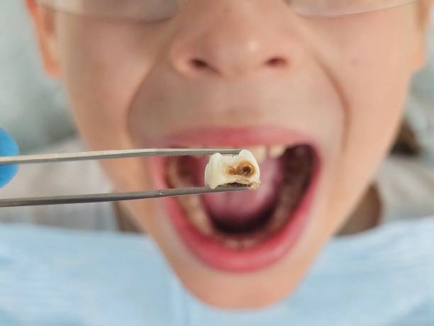 Best Emergency Wisdom Teeth Removal in Memphis, TX