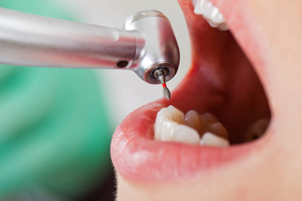 Best Emergency Tooth Extraction in Memphis, TX